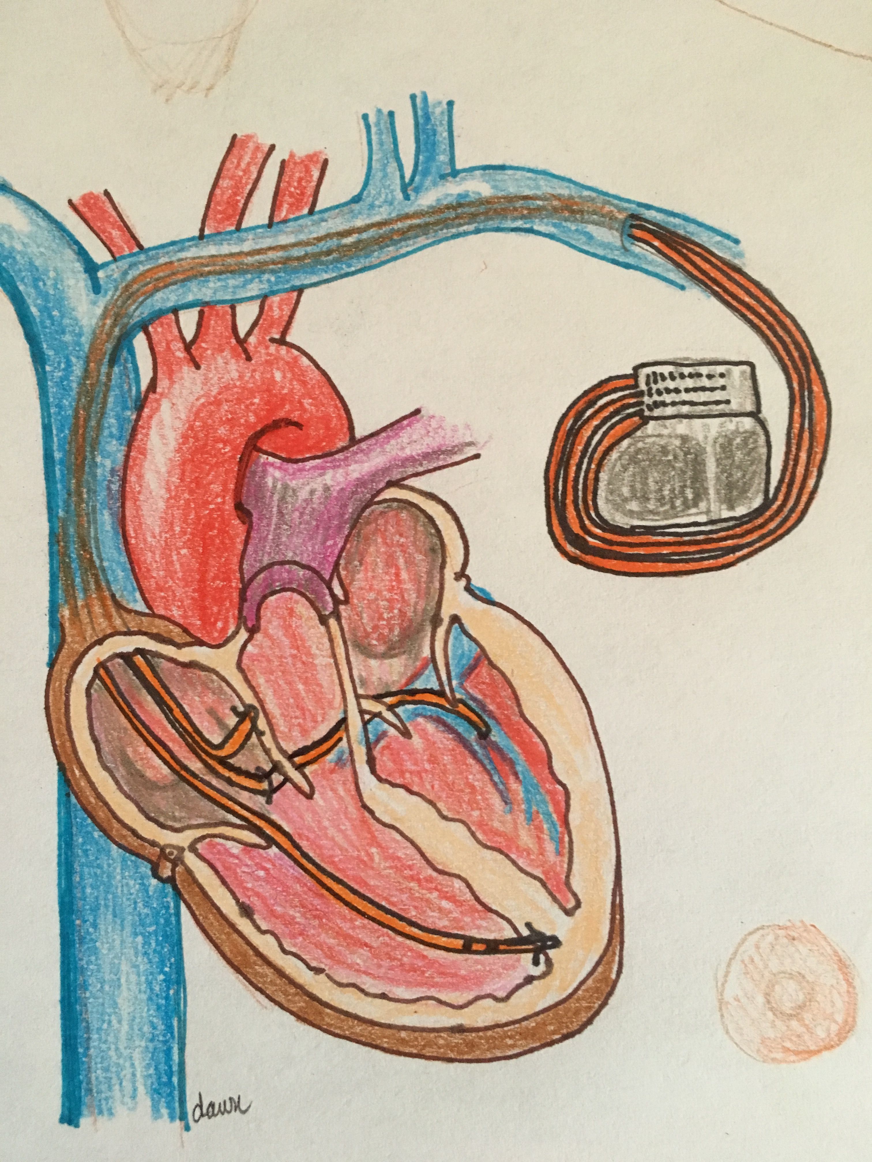 dual-chamber-pacemaker-illustration-ecg-guru-instructor-resources